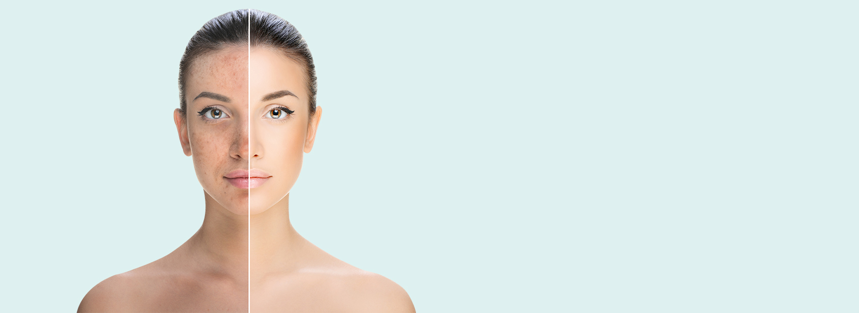 Skin Pigmentation Treatment