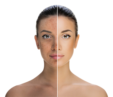 Skin Pigmentation Treatment