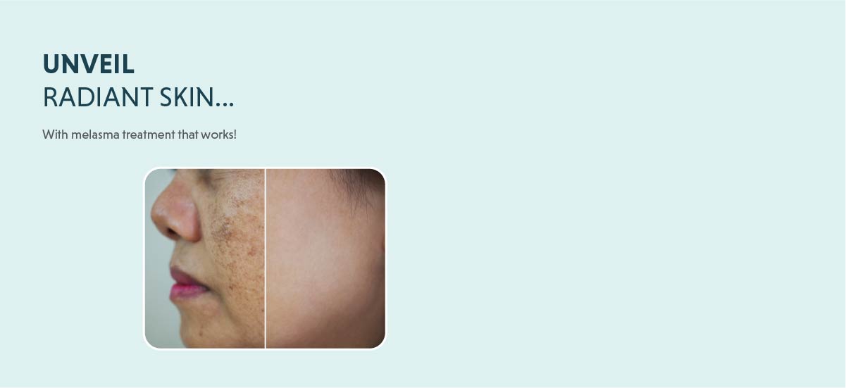 melasma treatment