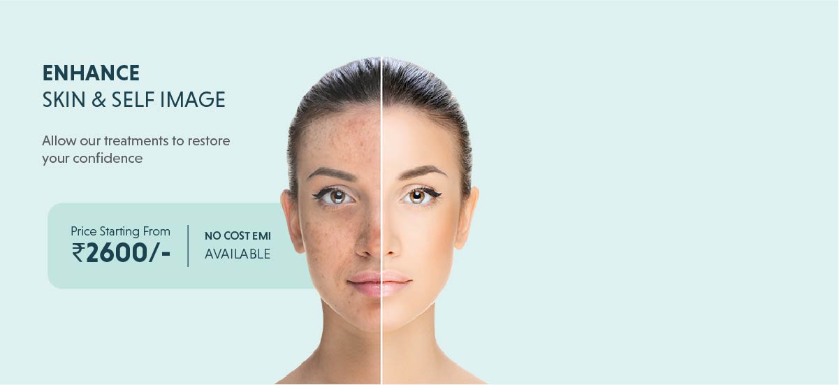 Pigmentation Treatment