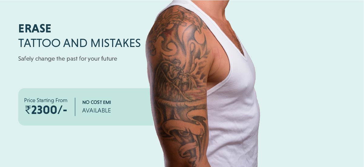 Tatto Removal treatment