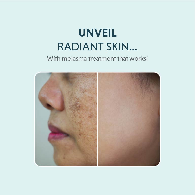 melasma treatment