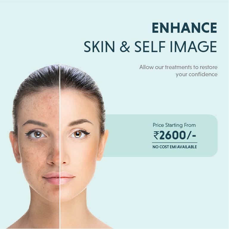 Pigmentation Treatment