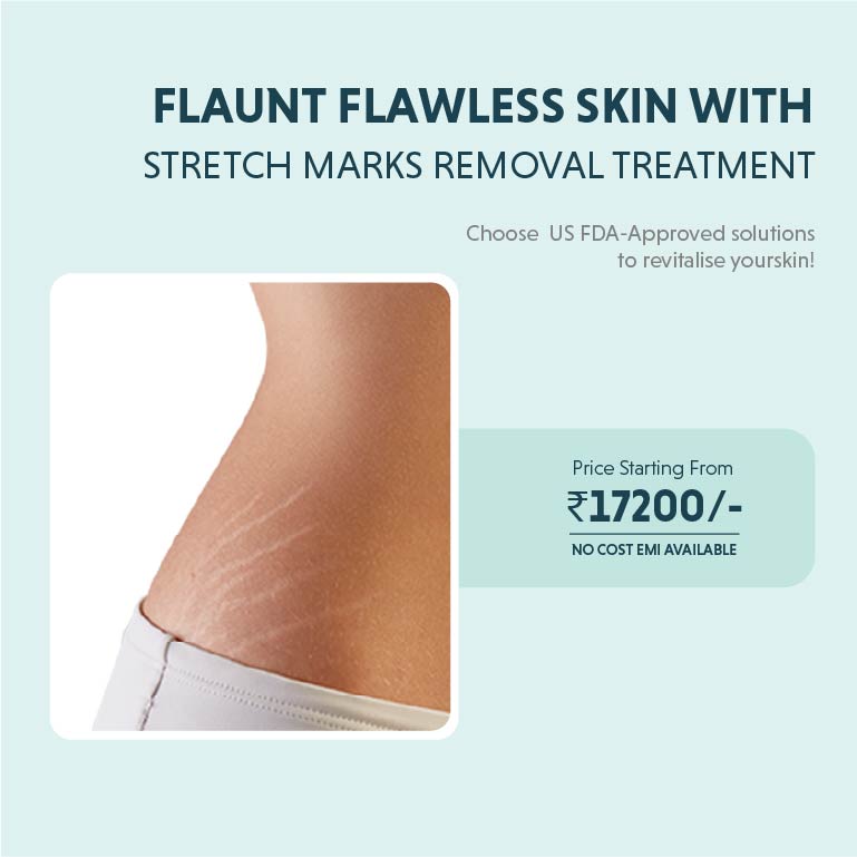 Stretch mark removal treatment 