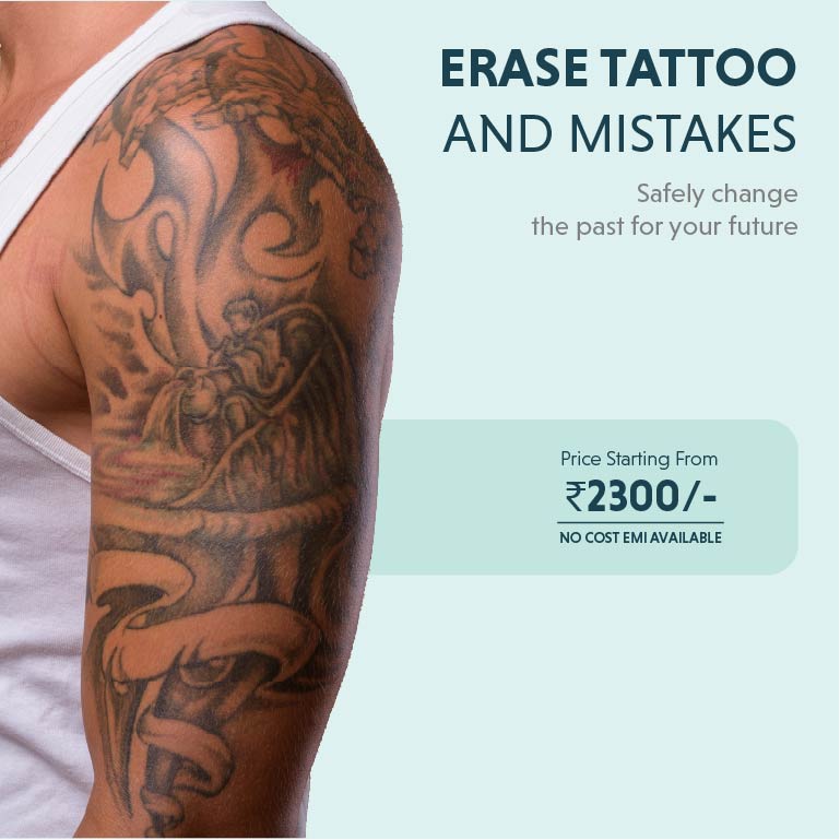 Tatto Removal treatment