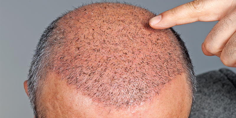 hair transplant