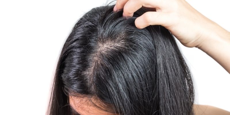 dry scalp and hair loss