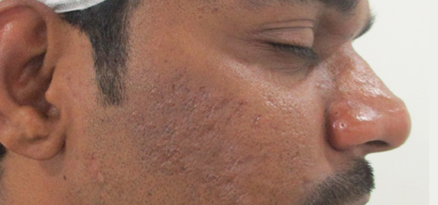 Acne scar treatment Before - Vasudev @olivaclinic