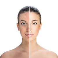 Skin pigmentation treatment in chennai