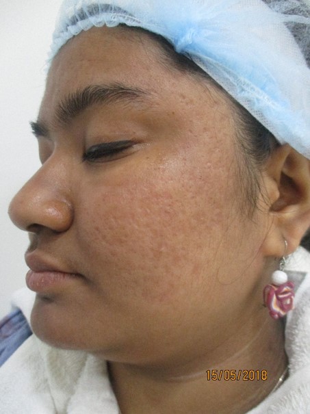 Acne treatment After - Dhana @olivaclinic