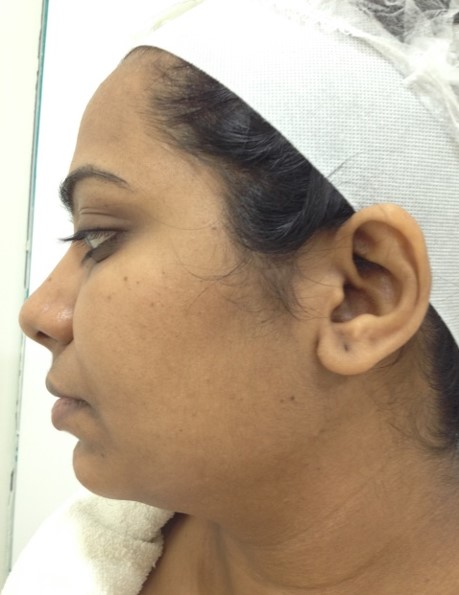 Skin lightening treatment After - Sravani @olivaclinic