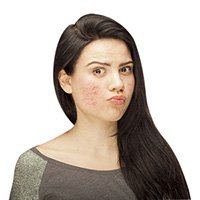 Pimples Treatment