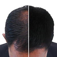 Hair Loss Treatment