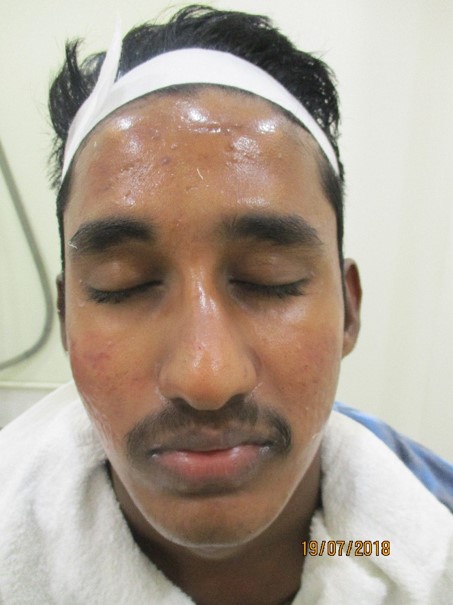 Acne treatment After - Saravana @olivaclinic