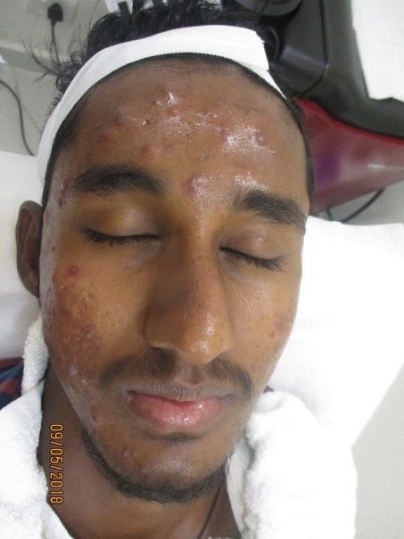 Acne treatment Before - Saravana @olivaclinic