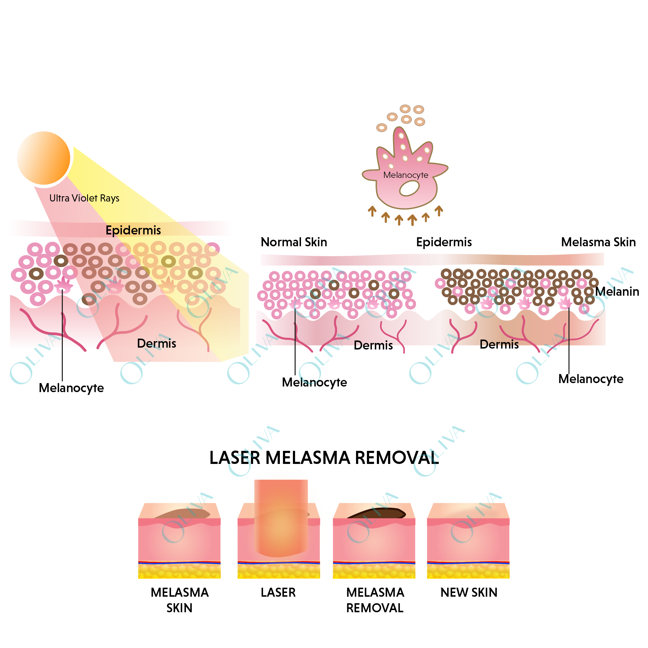 melasma infographics