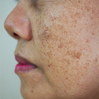 Melasma Treatment