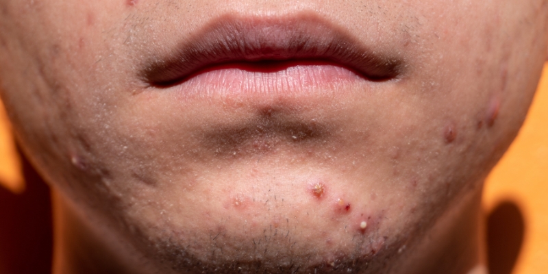 pimple around mouth