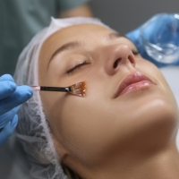 Chemical Peel Treatment