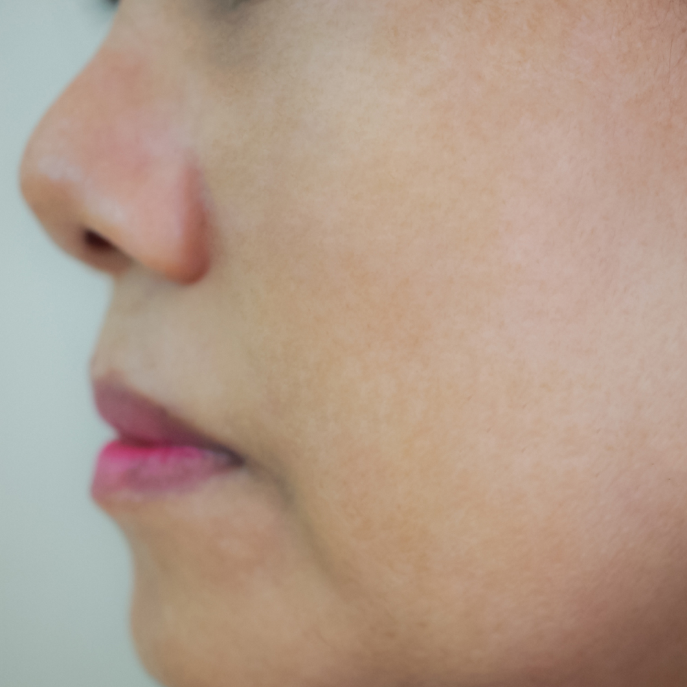 Melasma Treatment After Results