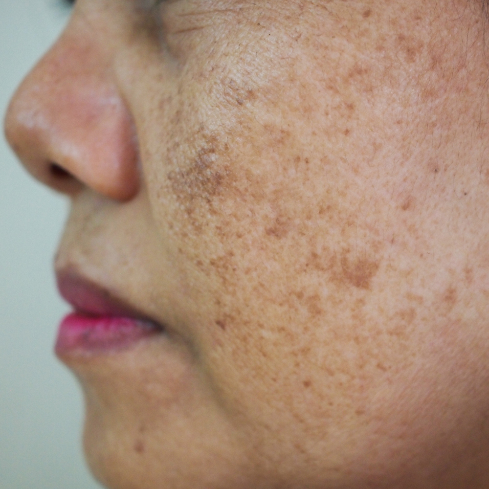 Melasma Treatment Before