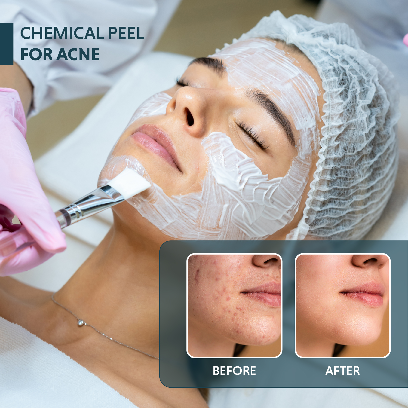 Chemical Peel for Acne