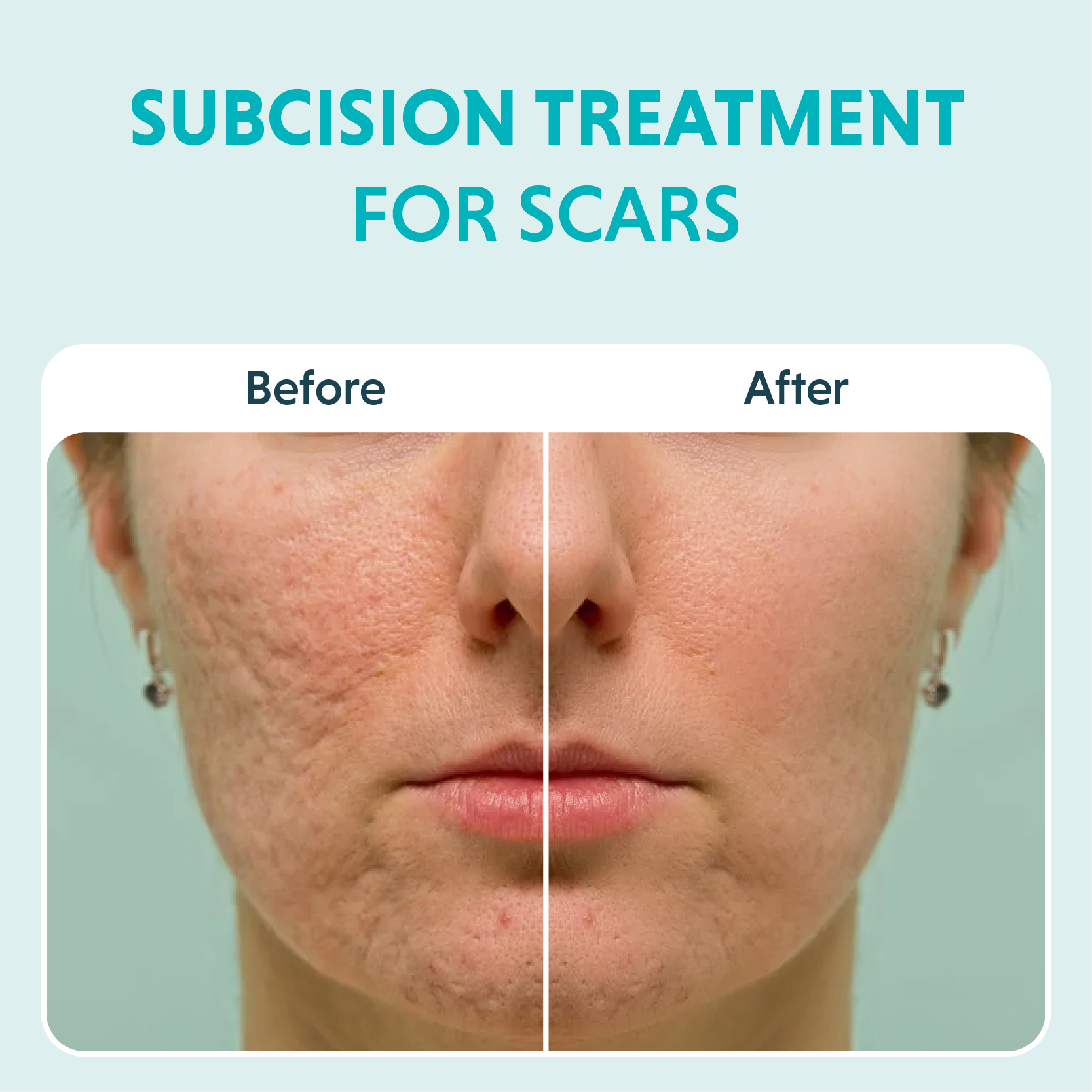 Subcision Treatment For Acne Scars