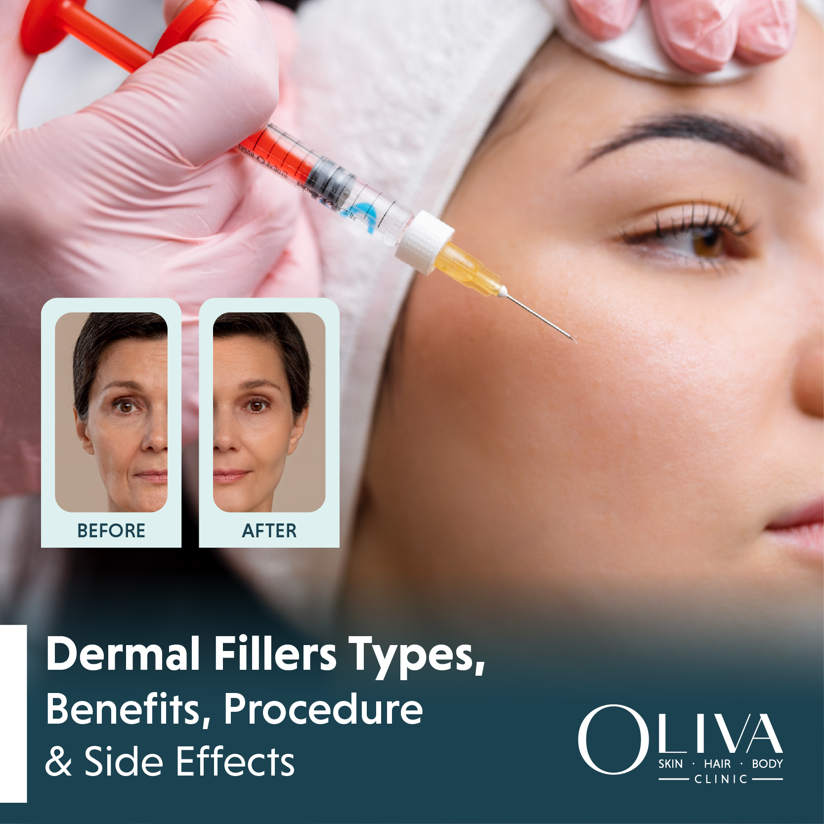 Dermal Fillers Types, Benefits, Procedure & Side Effects