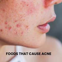 FOODS-THAT-CAUSE-ACNE