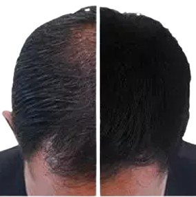 Hair Loss Treatment