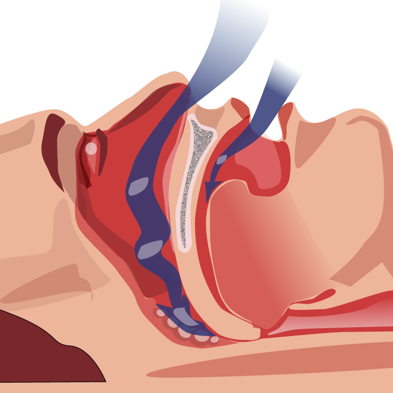 sleep apnea