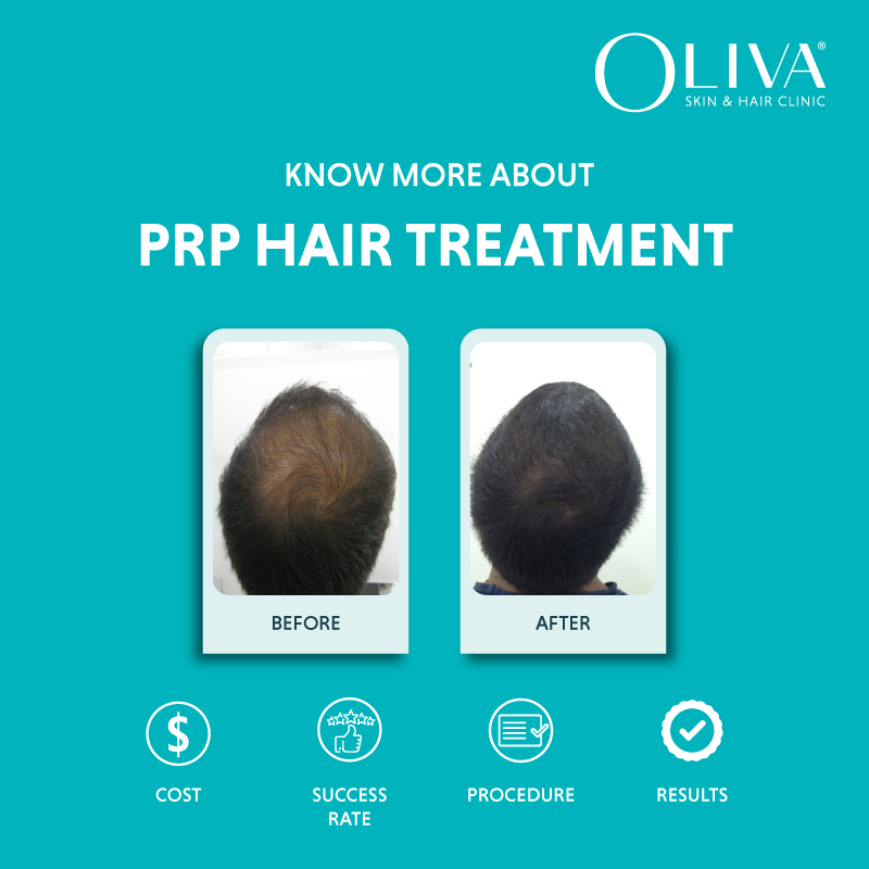 PRP Hair Treatment Cost In India – PRP Injection Starts At INR 5,500