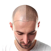 Hair Transplant Treatment