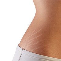 Stretch Marks Removal