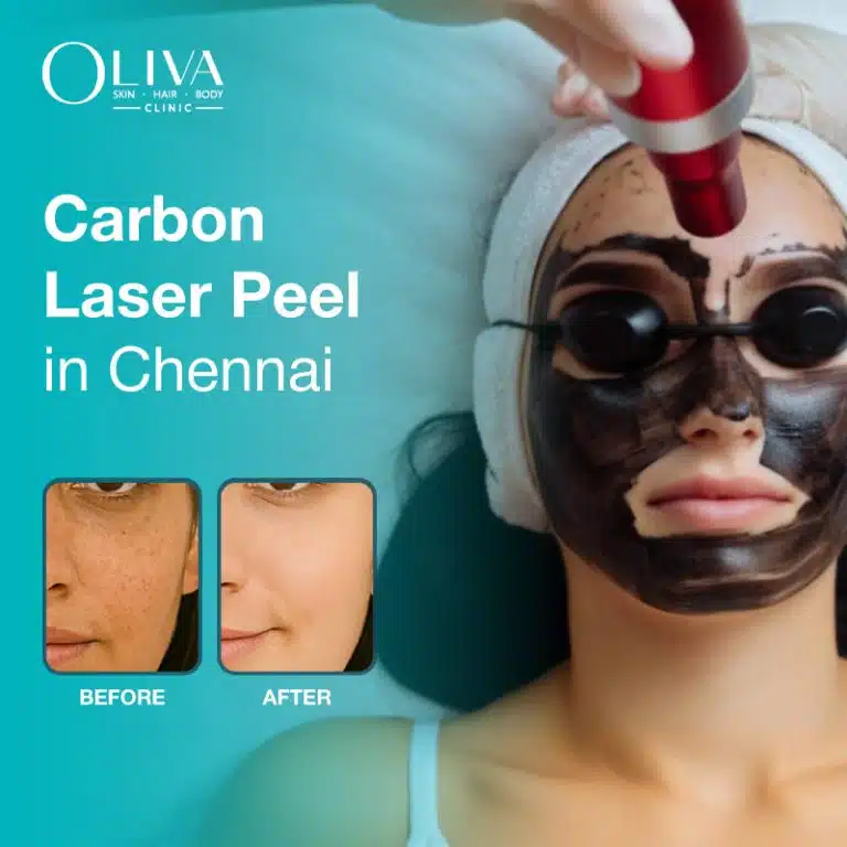 carbon laser treatment in chennai