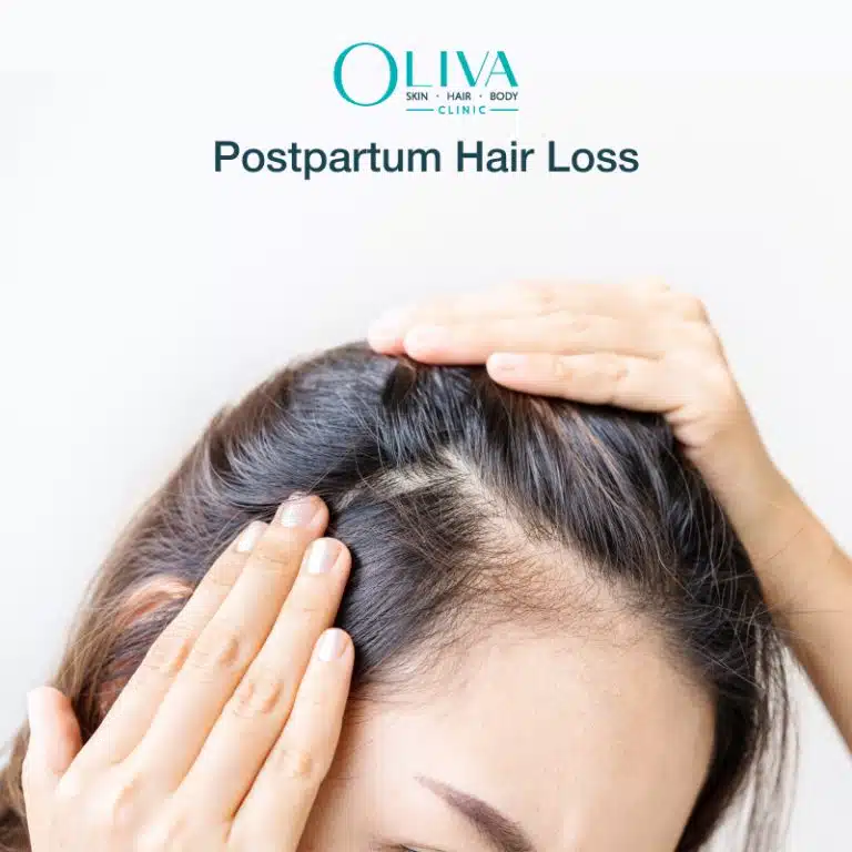 postpartum hair loss