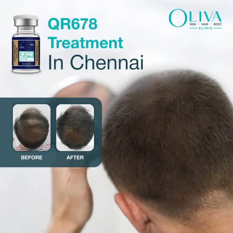 qr678 hair treatment in chennai