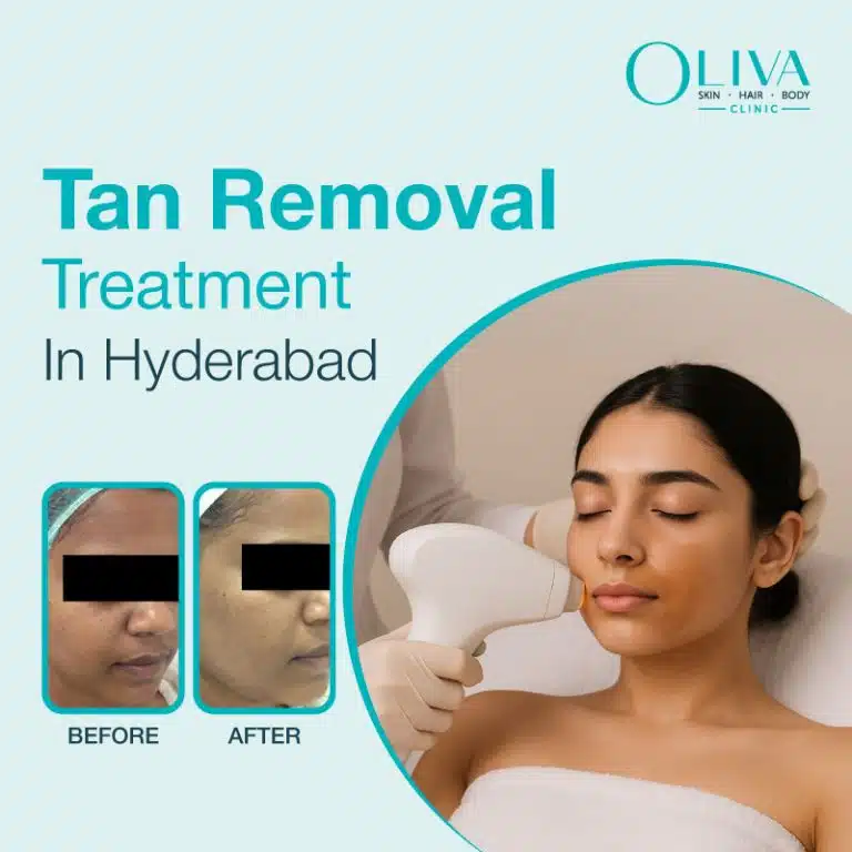 tan removal treatment in hyderabad