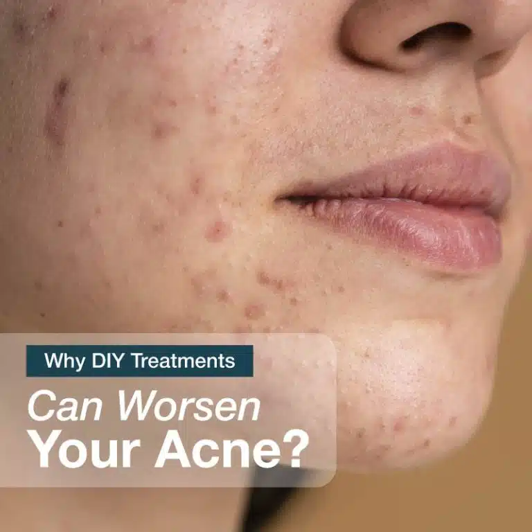 diy treatments for acne