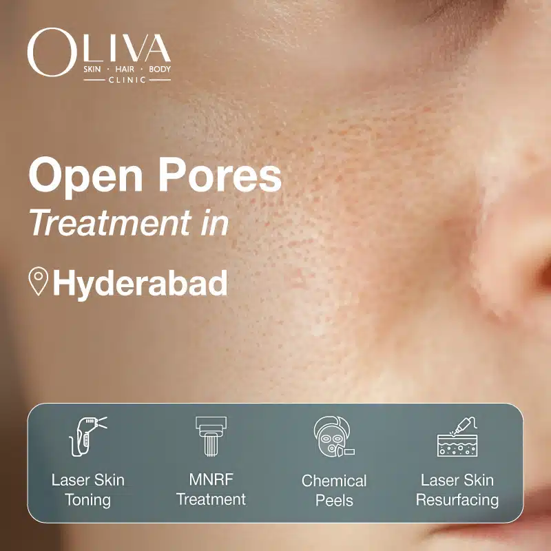 open pores treatment in hyderabad