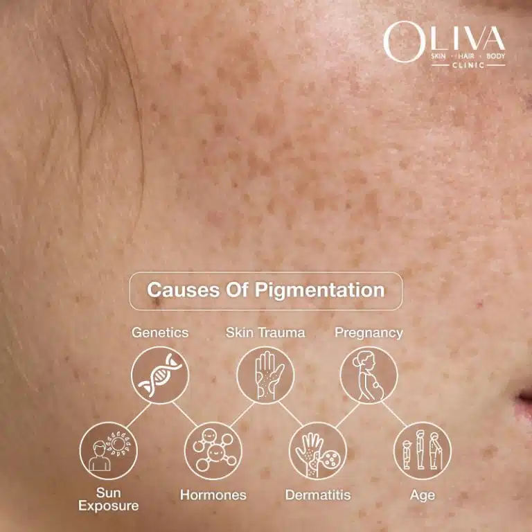 Causes-Of-Pigmentation