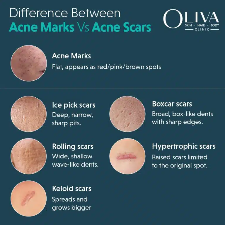 Difference Acne Marks Vs Acne Scars
