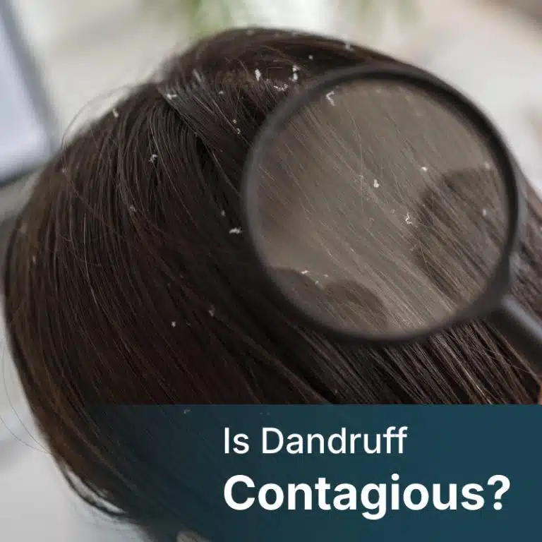 is dandruff contagious