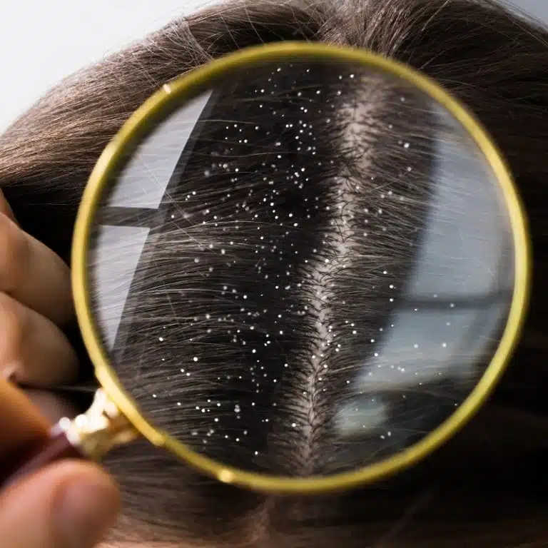 faqs on causes of dandruff