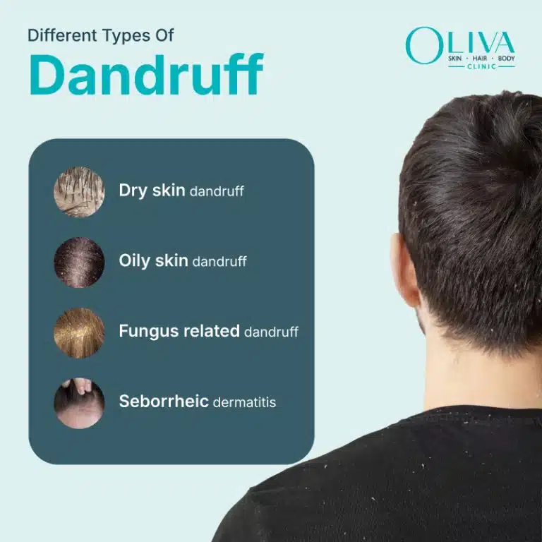 types of dandruff