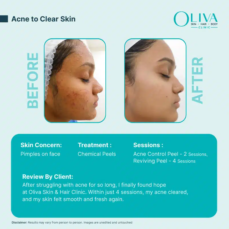 Acne to clear skin