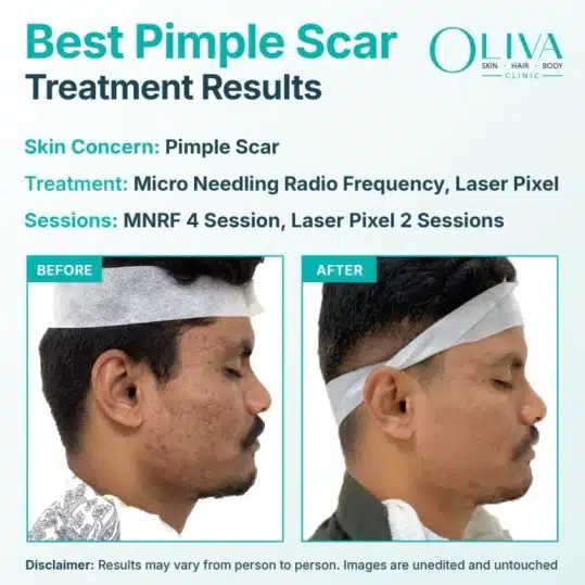 Pimple Scar Treatment